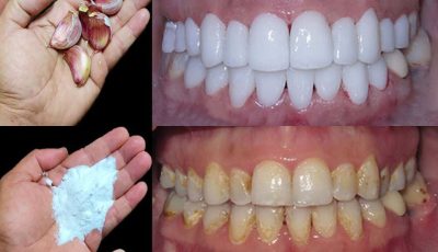 Cómo blanquear los dientes en 2 minutos?