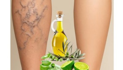 Remedio de la Abuela para las Várices: Receta Natural con Aloe Vera, Vinagre y Limón