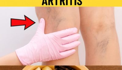 “Receta con Ajo, Clavos y Jengibre para Aliviar el Dolor de Piernas, Venas varicos, Reumatismo y Artritis”