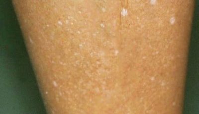 REMEDIOS CASEROS PARA TRATAR INFECCIÓN DE HONGOS EN LA PIEL