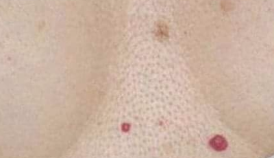 ¿Tienes estos puntos rojos en alguna zona de tu cuerpo? debes saber esto.