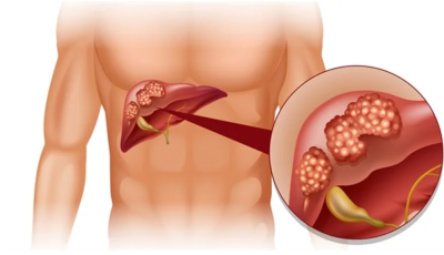 ¿Qué sucede con tu cuerpo cuando te quitan la vesícula?
