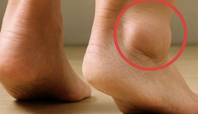 piernas-hinchadas-cuales-son-los-sintomas-y-tratamientos