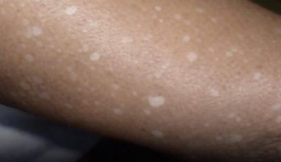 Pequeñas manchas blancas en brazos y piernas: lo que necesitas saber