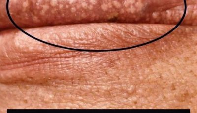 Si te salen granitos blancos en los labios o en la zona íntima, puede deberse a…