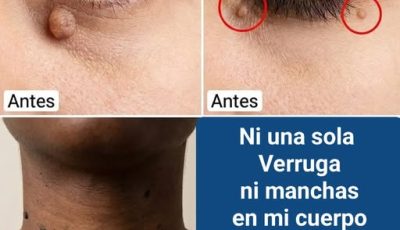 Como decirle adiós a las verrugas