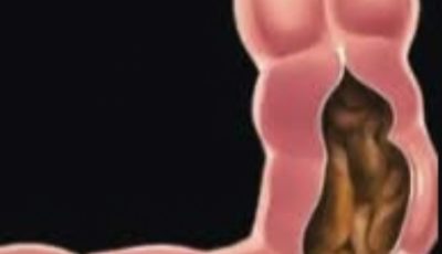 Drink Just 1 Glasses and Cleanse Your Entire Colon in 10 Minutes! Can’t Poop? This Morning Drink Will Clear You Out Fast