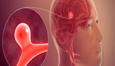 Cómo identificar los primeros signos y síntomas de un accidente cerebrovascular